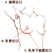 假体隆胸的切口选择