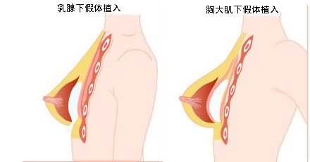 假体放置位置的选择。