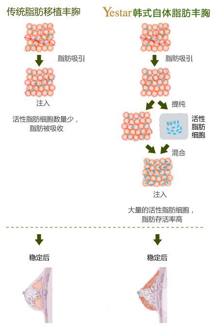 Yestar韩式自体脂肪隆胸