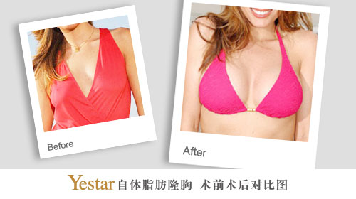 韩式自体脂肪隆胸术前术后对比图