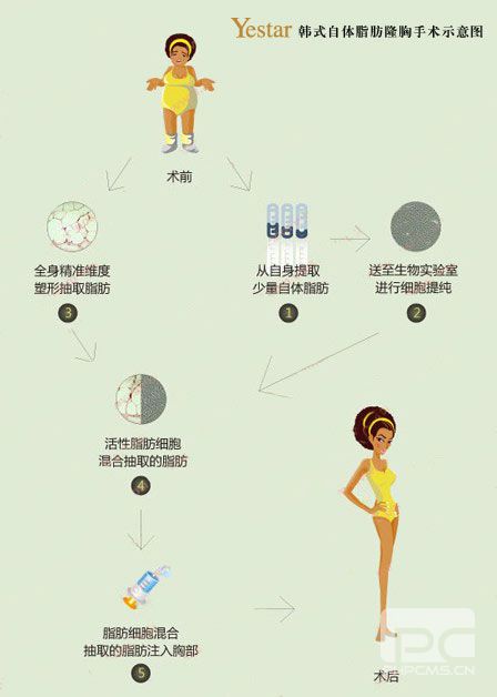 Yestar韩式自体脂肪隆胸手术示意图