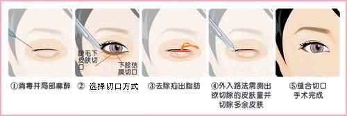 Yestar韩式无痕去眼袋与传统祛眼袋比较