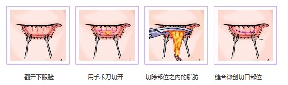 内路去眼袋过程图