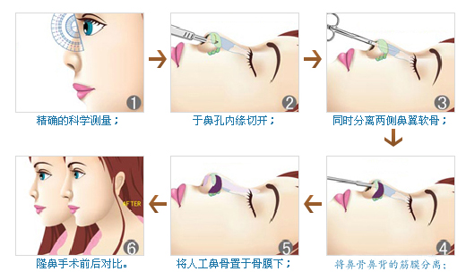 隆鼻过程