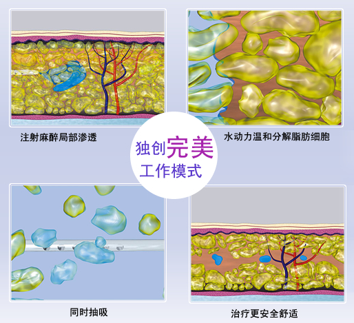 艺星水动力吸脂原理图