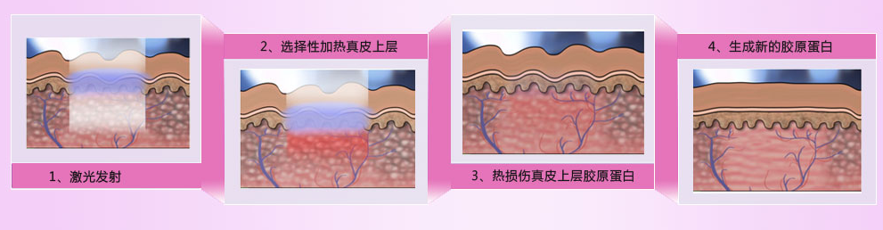 激光美白示意图