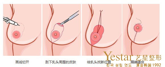乳房悬吊术矫正乳房下垂效果图