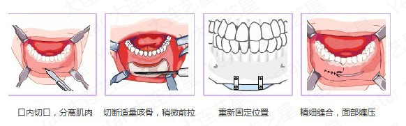 下巴整形