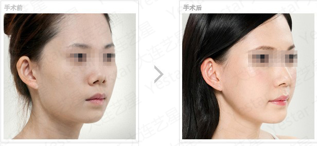 垫下巴前后对比