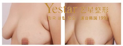 副乳切除对比图 \