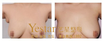吸脂副乳术 \