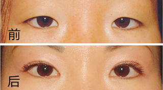 吸脂去肿眼泡