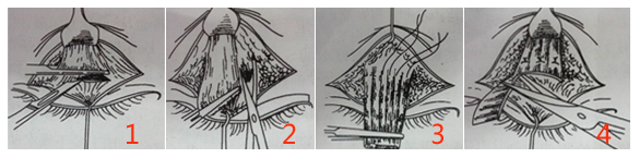 上睑提肌缩短过程