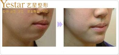 自体脂肪丰下巴术前术后对比图