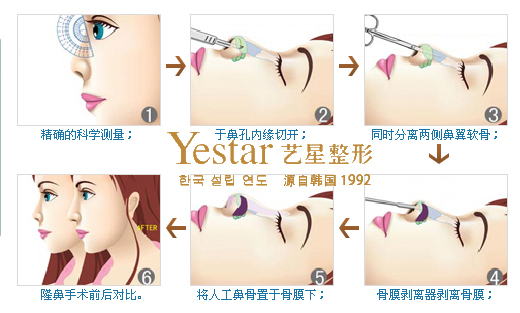 假体隆鼻过程