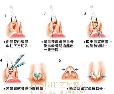 鼻孔缩小过程图