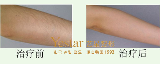 Yestar艺星手臂脱毛前后对比图