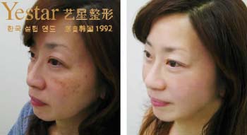 大连艺星彩光嫩肤对比