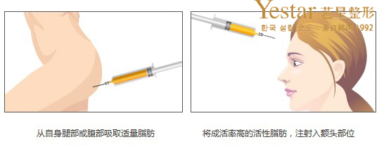 自体脂肪丰额头原理图