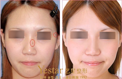 上海激光点痣多少钱