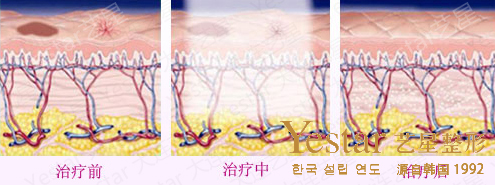 激光去疤痕原理图