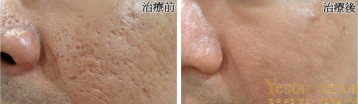 痘印,祛痘印,痘印去除