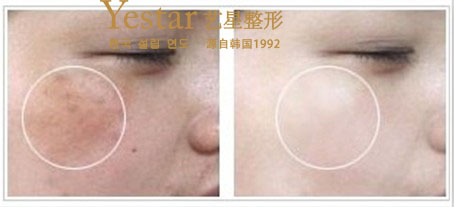 咖啡斑效果图
