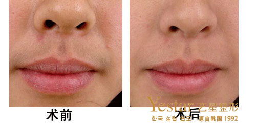 面部脱毛效果图