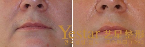 艺星唇部脱毛效果图