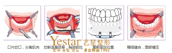 下巴整形过程图