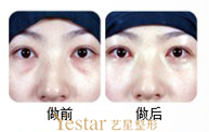 艺星眼部吸脂效果图