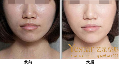 艺星激光美白效果图