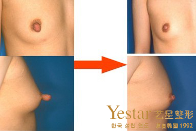 乳头乳晕缩小效果怎么样