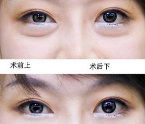 祛眼袋要多少钱