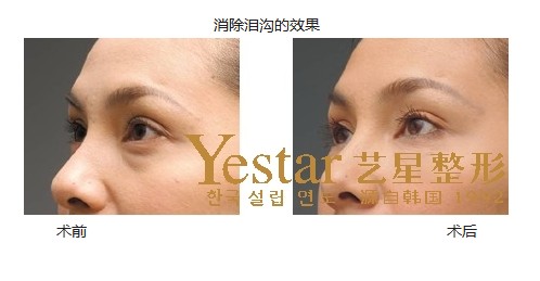 什么是泪沟填充