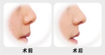 玻尿酸隆鼻效果图