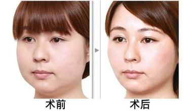 面部吸脂价格