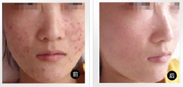怎么祛痘