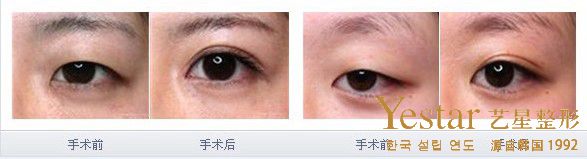 割双眼皮的注意事项有哪些