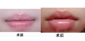 上海长宁区玻尿酸丰唇有什么特点呢