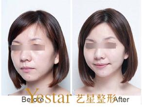 上海光子嫩肤有什么优势