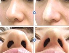 鼻尖整形手术如何做
