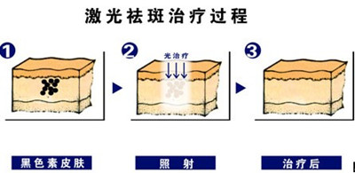 激光祛斑