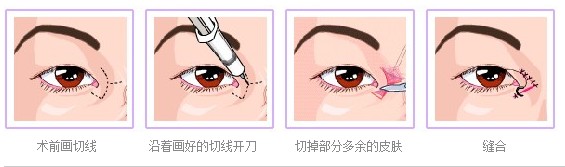 开眼角