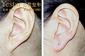 玻尿酸丰耳垂