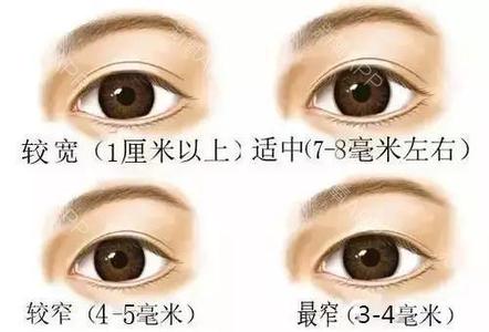 上海双眼皮的修复