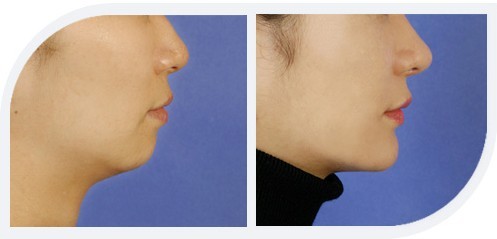 艺星玻尿酸隆下巴的优势