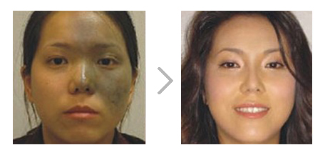 激光去太田痣怎么样