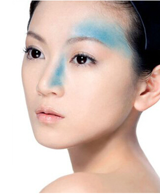 艺星去除胎记有哪些优点