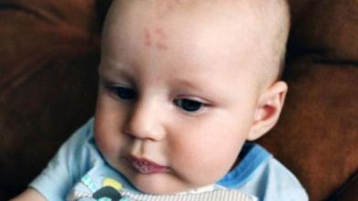 祛胎记有什么方法